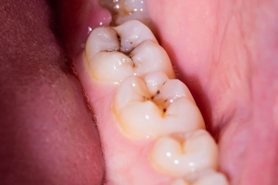 Dentist examining a large dental cavity